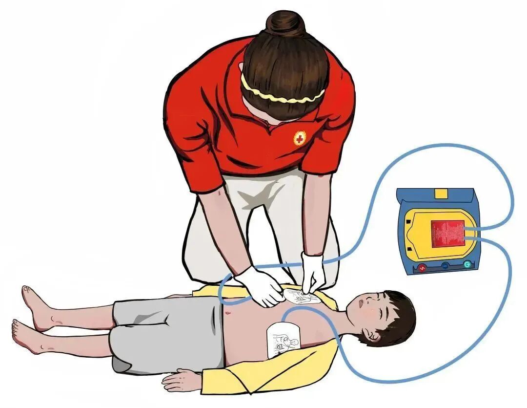 aed电极贴怎么贴急救知识 ｜ 如何正确使用AED？_https://www.jmylbn.com_新闻资讯_第10张