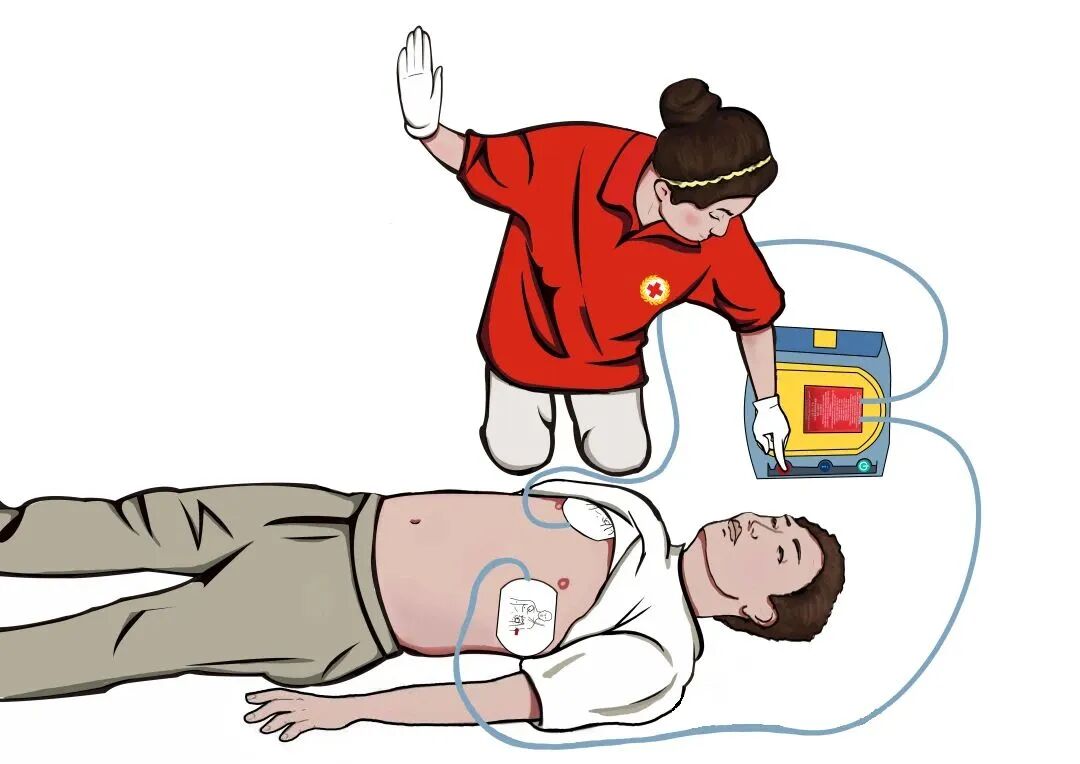 aed电极贴怎么贴急救知识 ｜ 如何正确使用AED？_https://www.jmylbn.com_新闻资讯_第12张