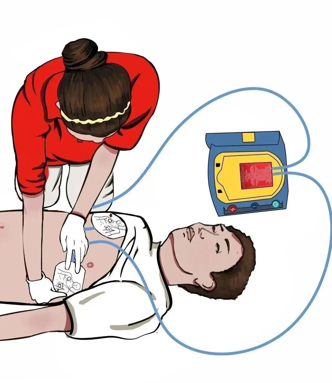 aed电极贴怎么贴急救知识 ｜ 如何正确使用AED？_https://www.jmylbn.com_新闻资讯_第8张