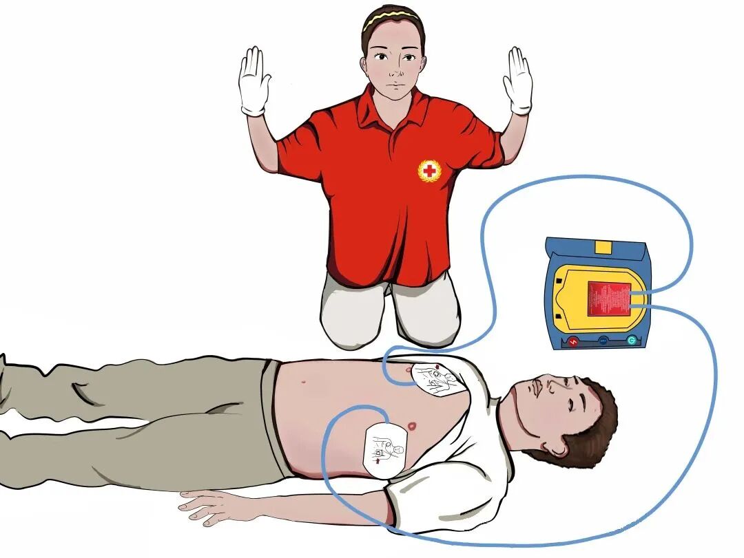 aed电极贴怎么贴急救知识 ｜ 如何正确使用AED？_https://www.jmylbn.com_新闻资讯_第11张