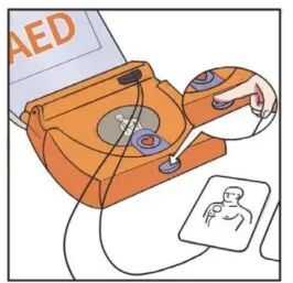 aed电极贴怎么贴急救知识 ｜ 如何正确使用AED？_https://www.jmylbn.com_新闻资讯_第5张