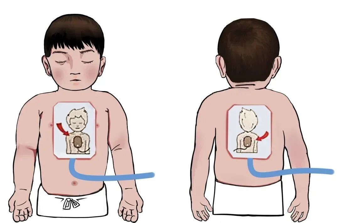 aed电极贴怎么贴急救知识 ｜ 如何正确使用AED？_https://www.jmylbn.com_新闻资讯_第9张