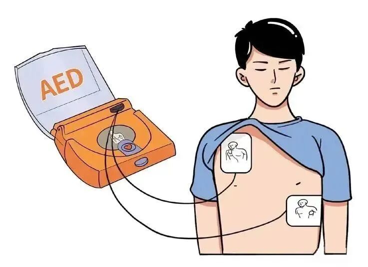 aed电极贴怎么贴急救知识 ｜ 如何正确使用AED？_https://www.jmylbn.com_新闻资讯_第4张