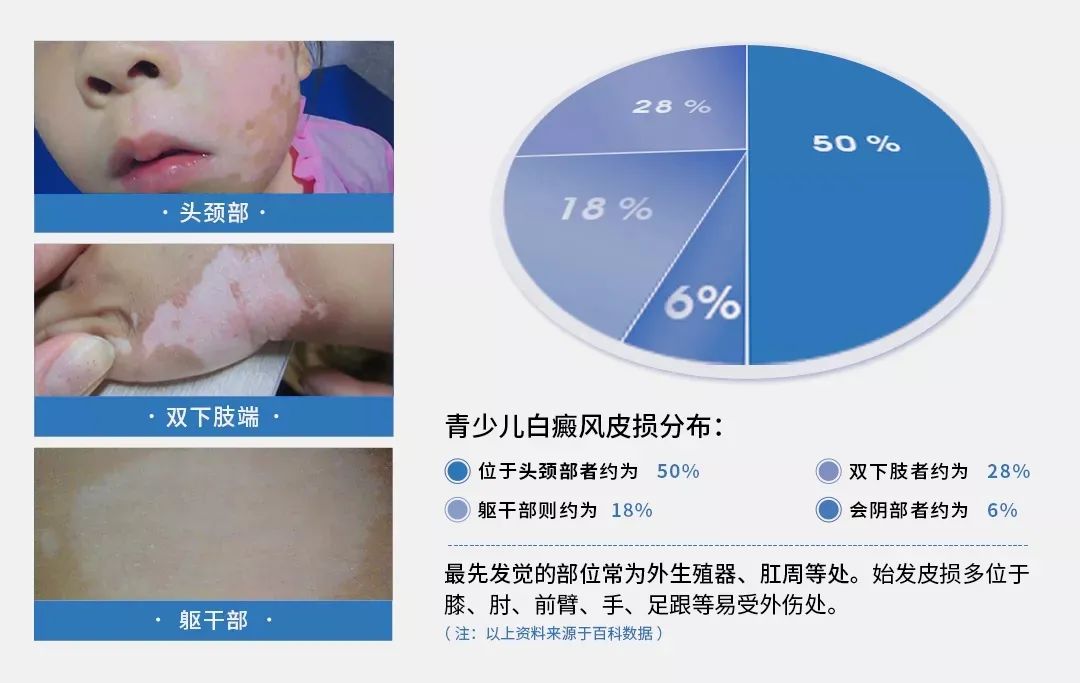 刚刚!2021年白癜风国家重点实验室最后一轮招募,患者100人!速点击申请!-微信头条网 刚刚!2021年白癜风国家重点实验室最后一轮招募,患者100人!速点击申请!