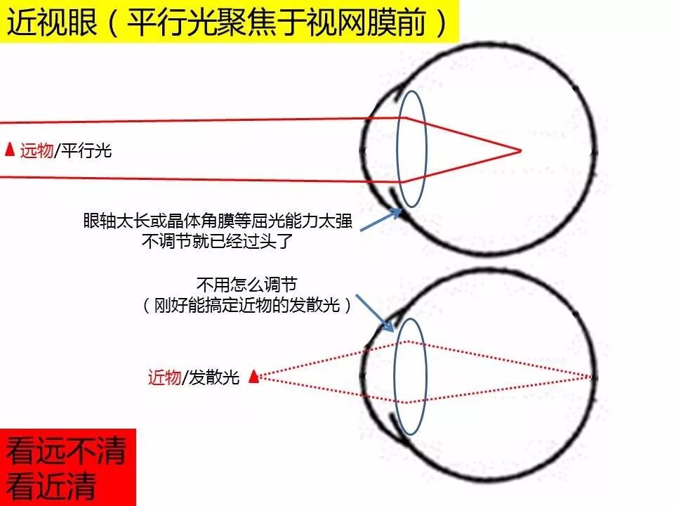 其实很多小孩子因为眼轴还没发育够长,相对来说屈光力比较弱,这种情况