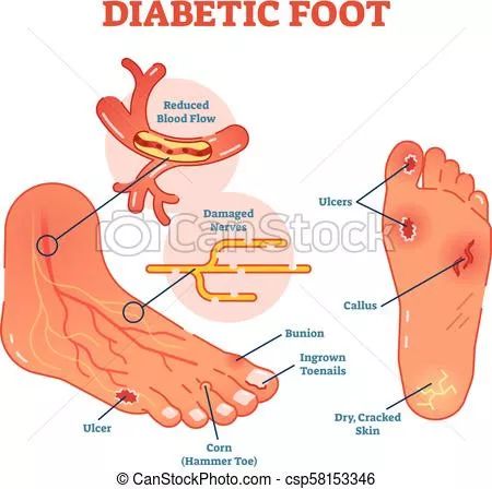 糖尿病為什麼那麼難纏 健康 第9張