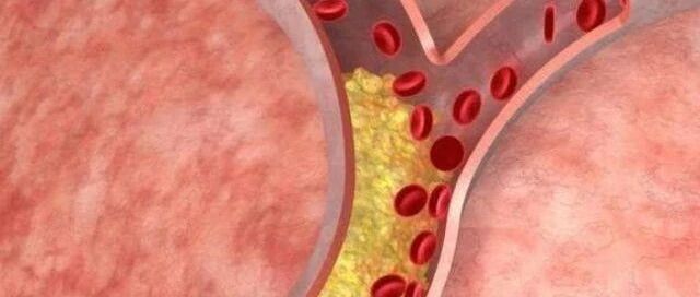 体检发现颈动脉斑块，这可怎么办？