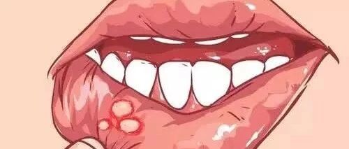 为什么我的口腔溃疡总是反反复复好不了？