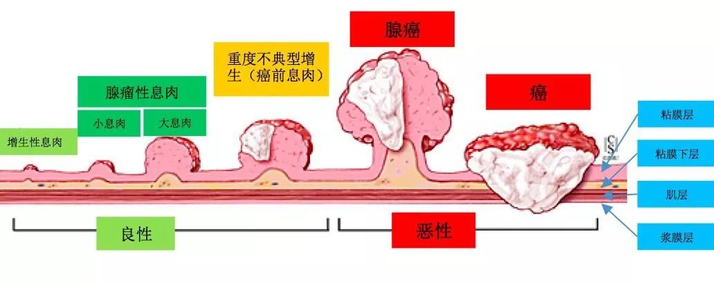 從息肉到腸癌：一條完全可以阻斷的路！ 健康 第2張