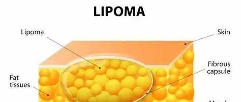 肩背长了不痛不痒的小包块，这可怎么办？