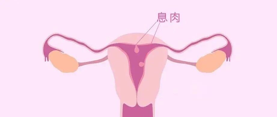 体检发现子宫内膜息肉该怎么办？
