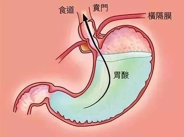 打嗝停不下來？警惕中風和胃腸道疾病！ 健康 第5張