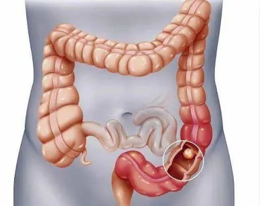 结肠黑变病是怎么回事儿?-友友