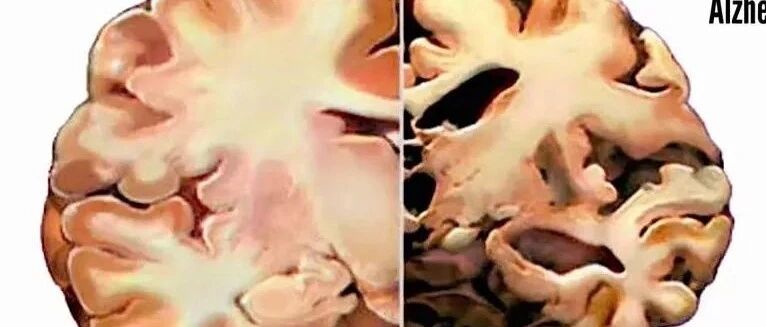 以前的事忘不了，眼前的事记不住？老年痴呆症的前兆？