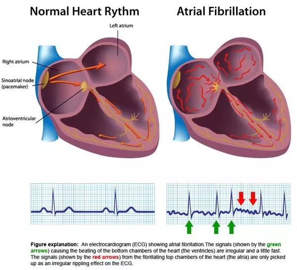 fibrillation)的简称,是一种快速性心律失常,简单来说就是心脏失控了