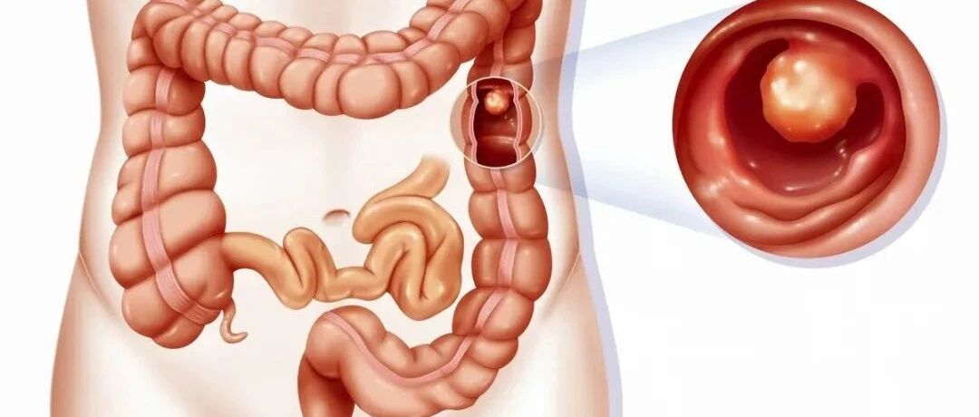 体检发现胃肠息肉应该怎么办？