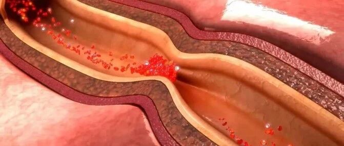 定期输液真的可以“打通”血管吗？