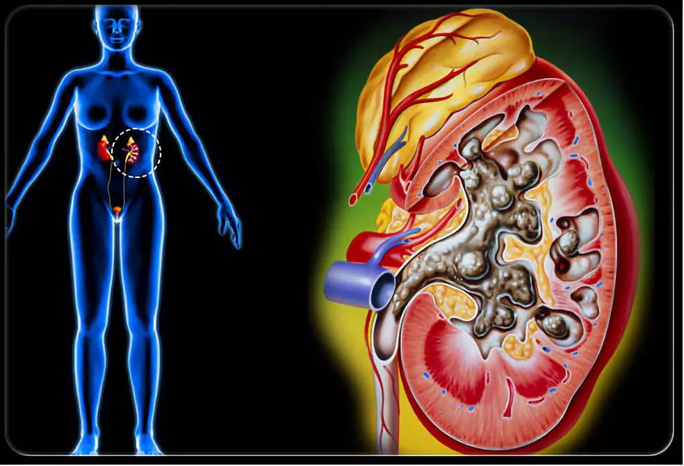 得了腎結石，醫生為什麼叫我多喝水？ 健康 第3張