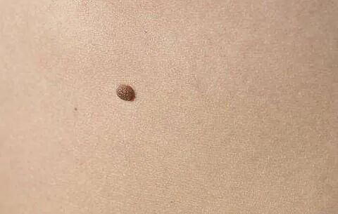 不管是灰痣黑痣都要留意恶变