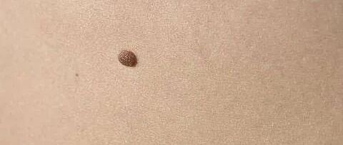 不管是灰痣黑痣，都要留意恶变