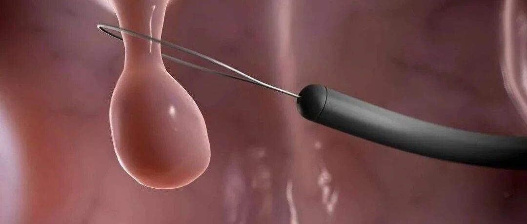 43岁知名演员罹患结肠癌去世，这种悲剧能不能幸免？