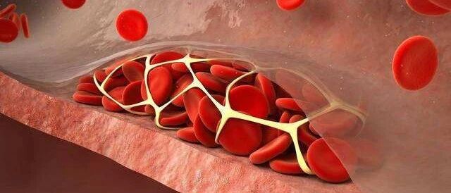 甘油三酯异常升高，中年人难逃的魔咒？