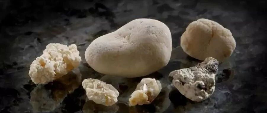 疼死人的尿路结石，有没有办法预防？