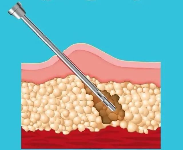 减肥手术多少钱_手术减肥_减肥手术有哪些方法