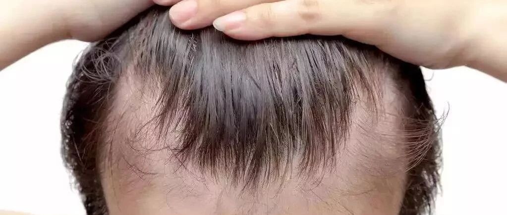 防止发际线后移和脱发，路在何方？