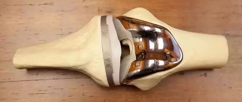 膝关节坏了，换个人工关节能用多久？