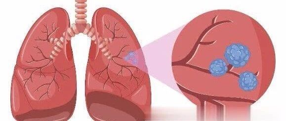 肺结节、甲状腺结节、乳腺结节...这可怎么办？