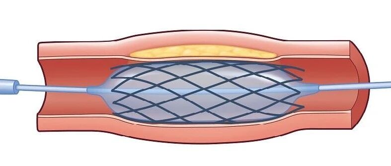 体检发现颈动脉斑块怎么办？