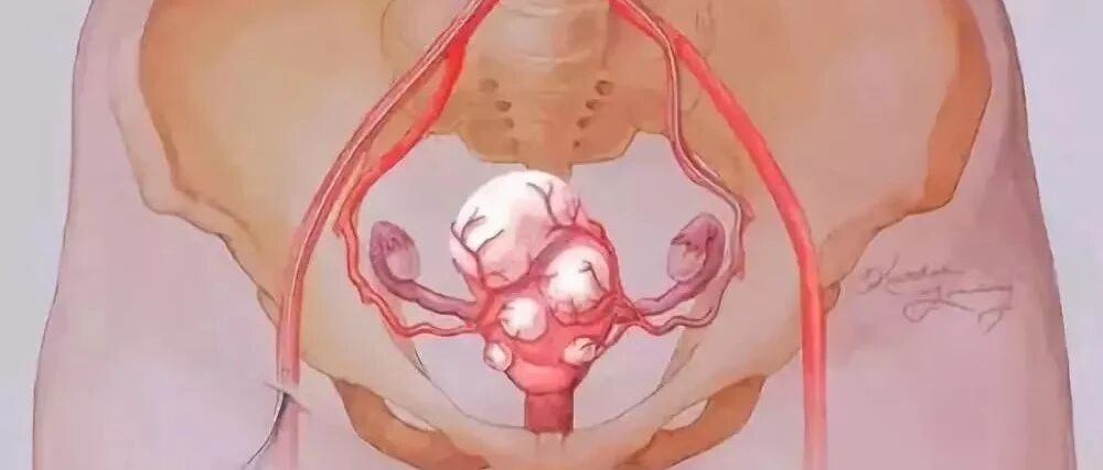 体检发现子宫肌瘤，该怎么办？