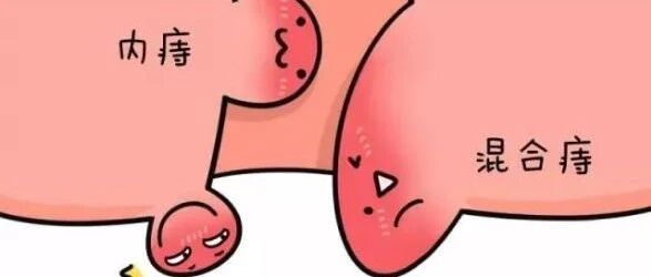 哎呀，肛门外什么时候长了一团小肉球？