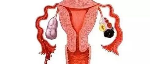 这种用“巧克力”冠名的囊肿到底是什么病？