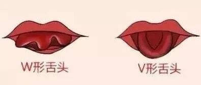 孩子拼音念不对，当心这个病！