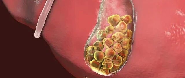 【疾病警惕】大便忽然变成白陶土色？警惕胆结石！