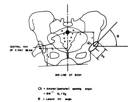 x线测量全髋关节置换术后髋臼假体前倾角的方法分析