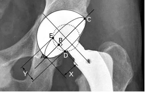x线测量全髋关节置换术后髋臼假体前倾角的方法分析