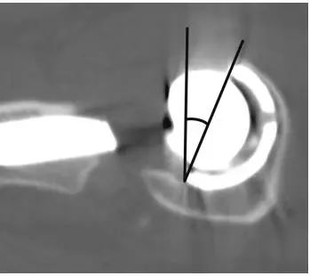 x线测量全髋关节置换术后髋臼假体前倾角的方法分析