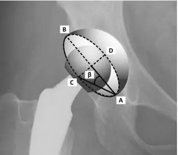 手术技巧:x线测量tha术后髋臼假体前倾角!
