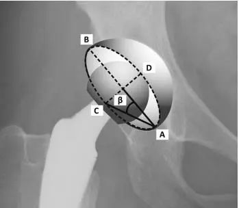 x线测量全髋关节置换术后髋臼假体前倾角的方法分析