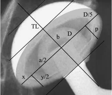 x线测量全髋关节置换术后髋臼假体前倾角的方法分析