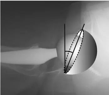 x线测量全髋关节置换术后髋臼假体前倾角的方法分析
