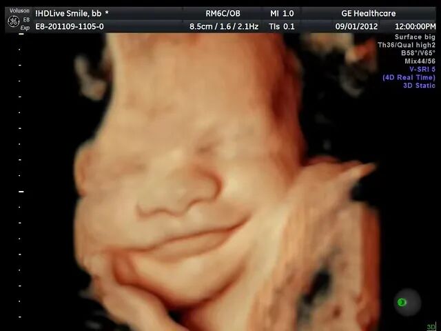 超声中什么黑什么白超声科普｜ 什么是B超_https://www.jmylbn.com_新闻资讯_第19张