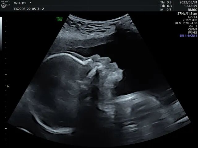 超声中什么黑什么白超声科普｜ 什么是B超_https://www.jmylbn.com_新闻资讯_第17张