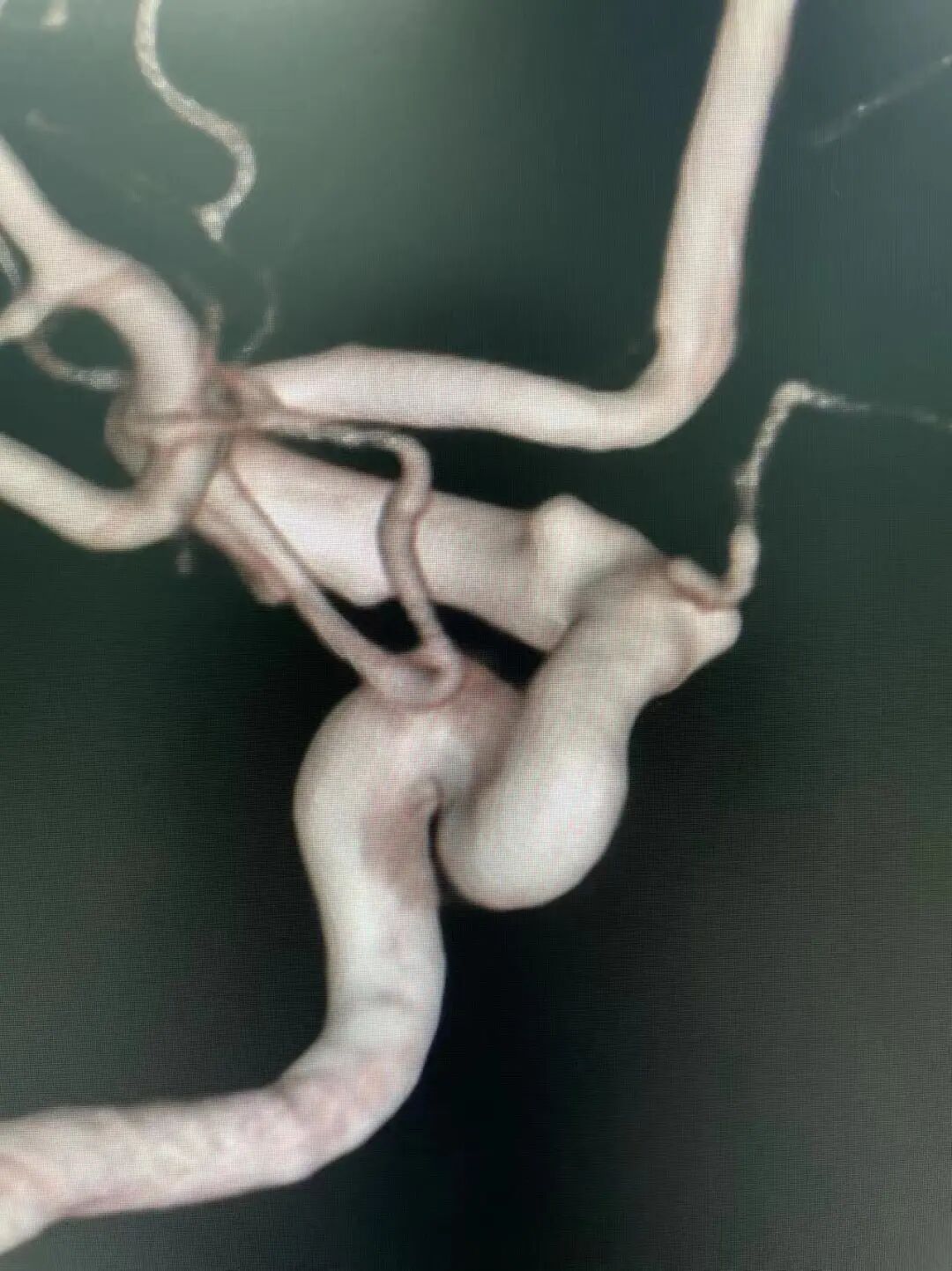 动脉长鞘怎么置入术说·第十七期丨Infinity长鞘助力Surpass Streamline血流导向密网支架治疗双侧颈内迂曲路径动脉瘤一例_https://www.jmylbn.com_新闻资讯_第9张