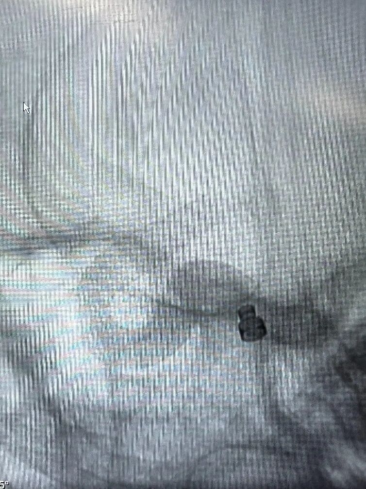 动脉长鞘怎么置入术说·第十七期丨Infinity长鞘助力Surpass Streamline血流导向密网支架治疗双侧颈内迂曲路径动脉瘤一例_https://www.jmylbn.com_新闻资讯_第22张