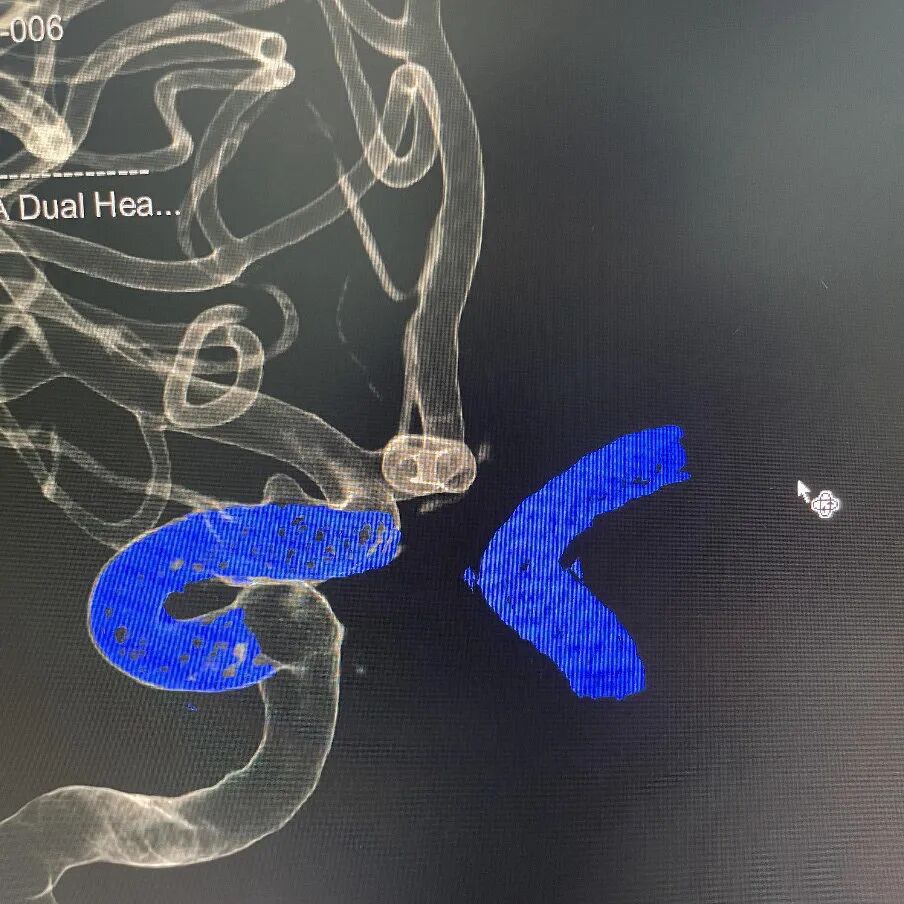 动脉长鞘怎么置入术说·第十七期丨Infinity长鞘助力Surpass Streamline血流导向密网支架治疗双侧颈内迂曲路径动脉瘤一例_https://www.jmylbn.com_新闻资讯_第33张