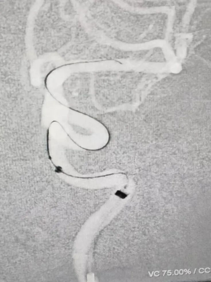 动脉长鞘怎么置入术说·第十七期丨Infinity长鞘助力Surpass Streamline血流导向密网支架治疗双侧颈内迂曲路径动脉瘤一例_https://www.jmylbn.com_新闻资讯_第11张